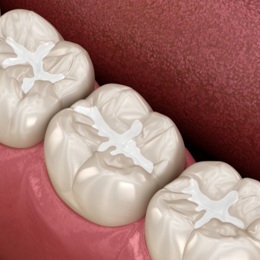Animated row of teeth with dental sealants placed by Chicago children's dentist