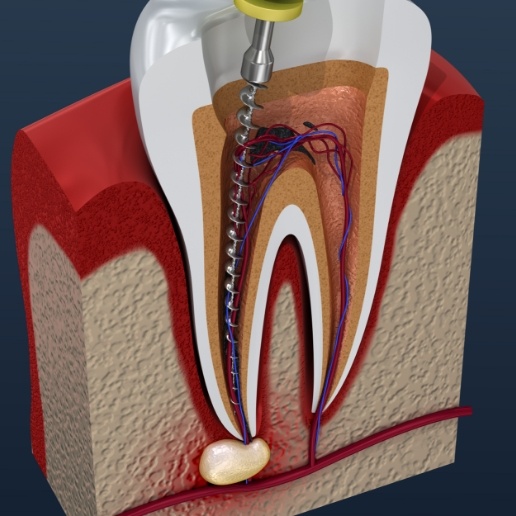 Animated tooth with infection inside of the root