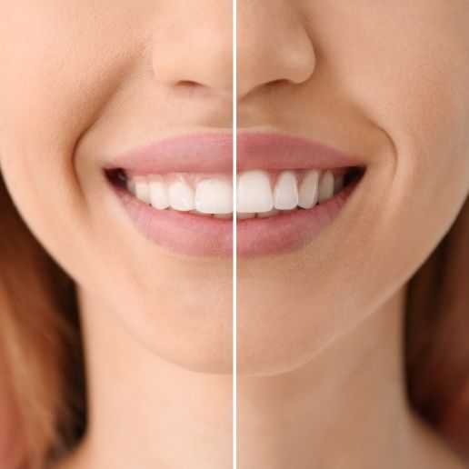 Woman smiling before and after getting gum recontouring to correct gummy smile