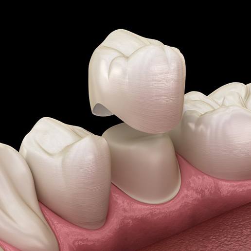 Exploded illustration of dental crown and tooth
