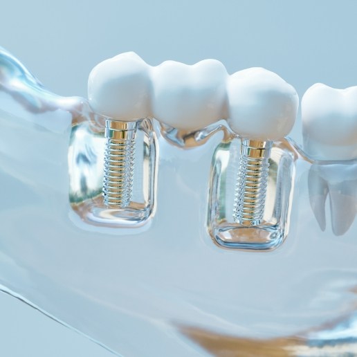 Model of two dental implants in Chicago