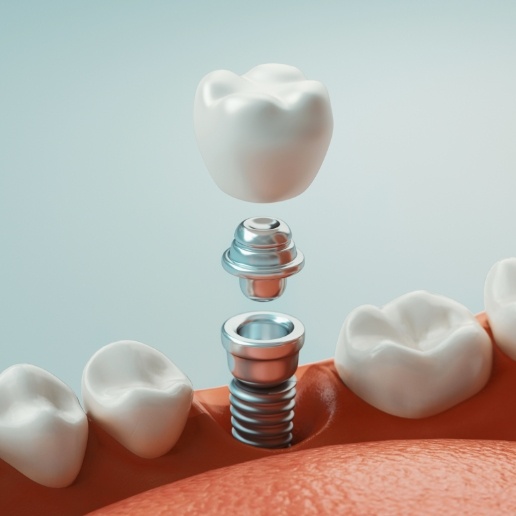 Animated dental implant with crown being placed in the lower jaw