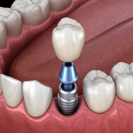 Dental implant with crown replacing one missing tooth