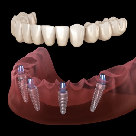 All on 4 implant denture replacing a row of missing teeth