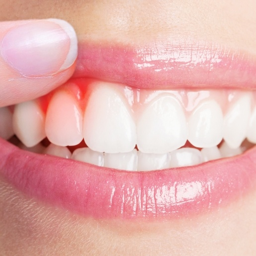 Close up of person with red gums who needs gum disease treatment in Chicago