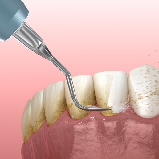 Animated dental tool removing plaque from teeth