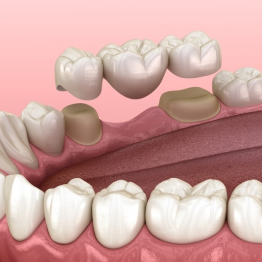 Animated dental bridge replacing a missing tooth in Chicago