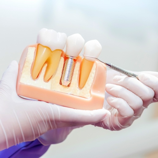 Dentist pointing to a model of a dental implant in the jaw