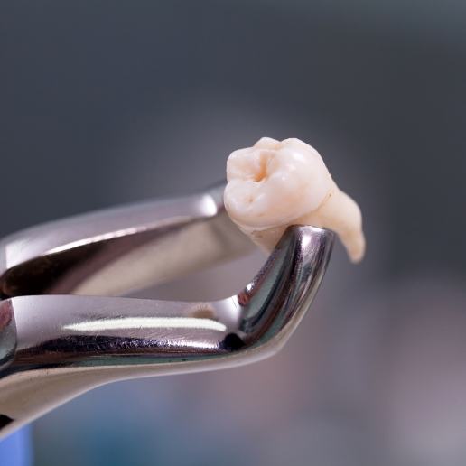 Tooth being held in a pair of dental forceps