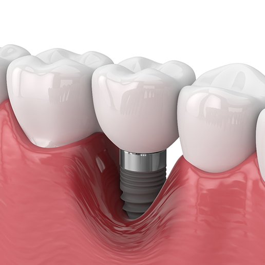 Illustration of bone loss around a dental implant in the lower arch