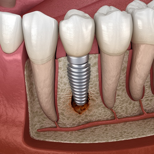 Illustration of bone loss around a failed dental implant