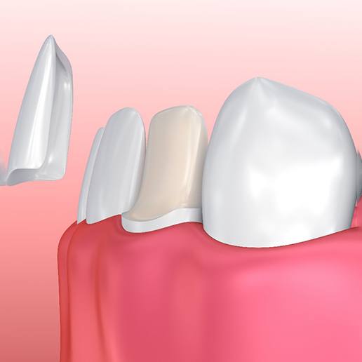 Illustration of veneer being placed on lower, front tooth