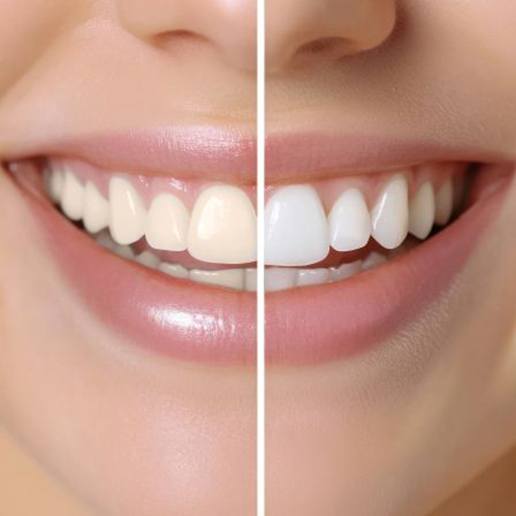 Close-up of woman’s smile before and after teeth whitening