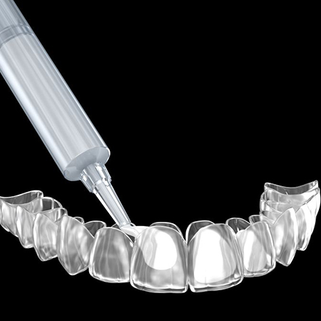 Illustration of whitening formula being placed in custom tooth tray