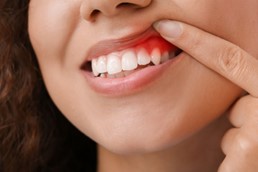 patient with gum disease lifting up lip to show gums