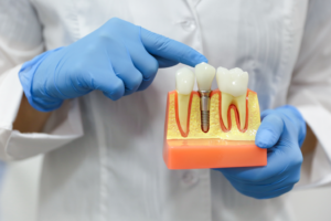 a dentist holding a dental implant model
