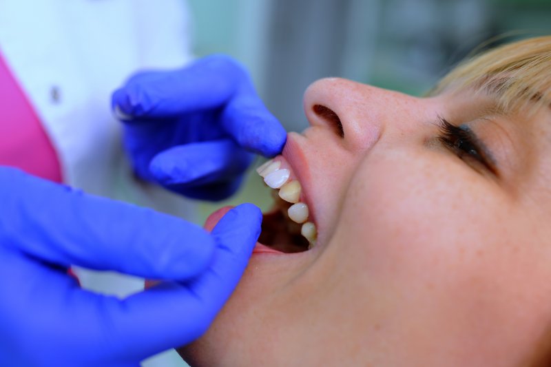 A dentist placing veneers over a woman’s teeth