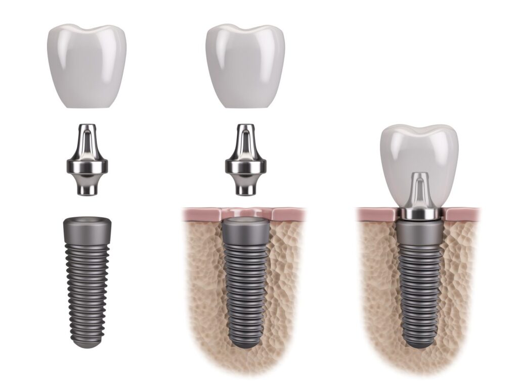 A computer-generated image of the parts of a dental implant.