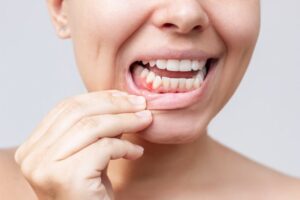 Person showing bump on gums.