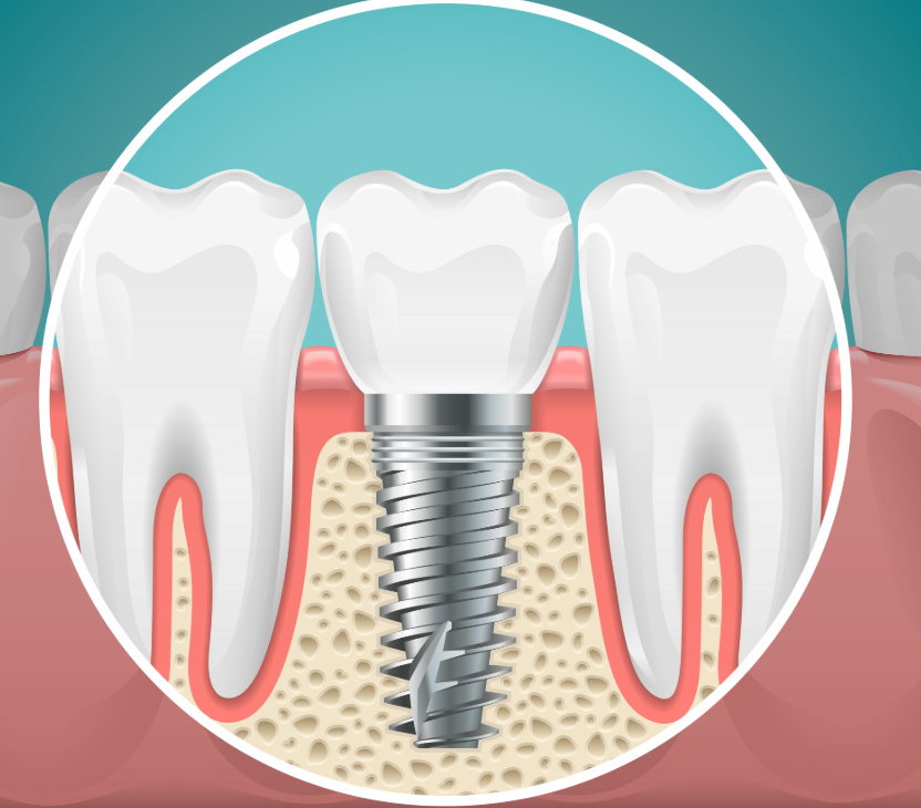 Illustrated cross section of a dental implant