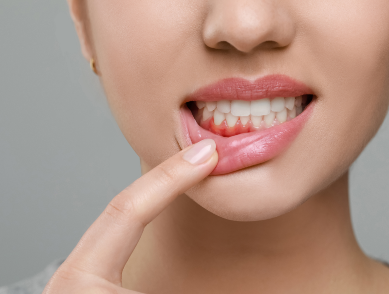 Close up of woman's mouth with inflamed gums